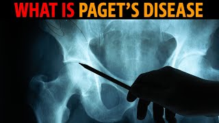 What is Pagets disease [upl. by Emsmus]