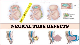 NeuraltubedefectsspinabifidameningomyelocelemeningoceleAnencephalyEncephalocele [upl. by Fulmer]