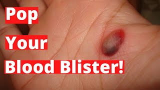 Should You Pop A Blood Blister [upl. by Fruin382]