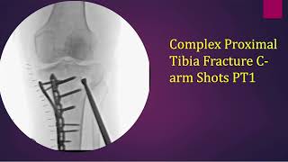 Orthoshots Three column plating proximal tibia tibial plateau fracture with diaphyseal extension [upl. by Zena]