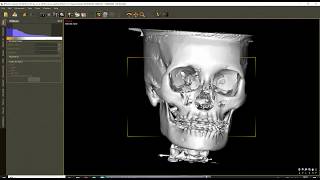 3D Orthognathic Planning with DDSPro [upl. by Alana939]