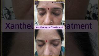 Xanthelasma removal treatment  Xanthelasma treatment laser  youtubeshort shorts xanthelasma [upl. by Bryant]