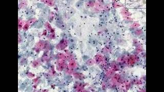 Histopathology Cervix  High grade squamous intraepithelial [upl. by Ricard]