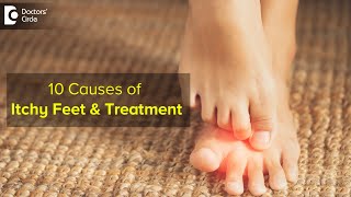 10 CAUSES OF ITCHY FEET How to get relief  Right Treatment  Dr Urmila Nischal Doctors Circle [upl. by Attelra]