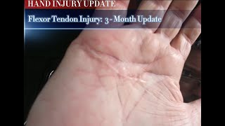 Flexor Tendon injury 3Month Update After Surgery [upl. by Egnalos]