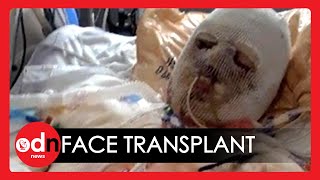 Worlds First Face and Hand Transplant Surgery Hailed a Success [upl. by Pickar]