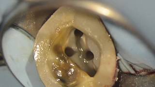 Traitement endodontique sous microscope 4 canaux  27 [upl. by Ettennod]