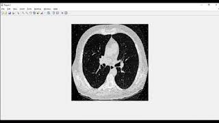 Lung Nodule Detection Deep Learning Matlab Projects [upl. by Mossman]