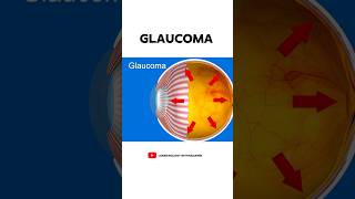 What is Glaucoma 👁️ [upl. by Garwin]