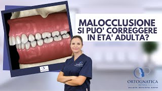 Malocclusioni dentoscheletriche è possibile correggerle in età adulta [upl. by Virgin]