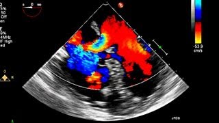 Atrial Septal Defect Primum Echocardiography [upl. by Kristie]