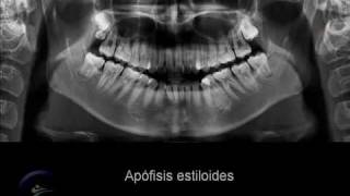 Anatomía en la radiografía panorámica II Anatomic panoramic image II [upl. by Ennaillek674]