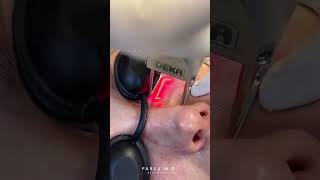 Watch the Under Eye Skin Tightening with Co2 Laser  Dr Kami Parsa [upl. by Eirahs]