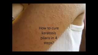 How to cure keratosis pilaris in 4 easy steps [upl. by Attenal]