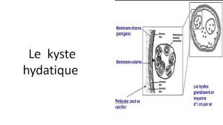 PNEUMOLOGIE KYSTE HYDATIQUE 2016 [upl. by Esina]