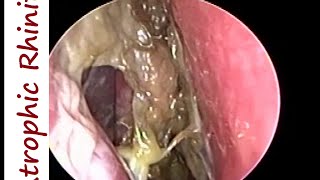 Atrophic Rhinitis Ozaena  Operated Youngs on Left amp Modified Youngs operation on Right [upl. by Ivers]