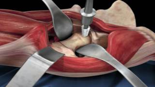 Direct Anterior Approach Hip Replacement [upl. by Llenna740]