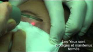 epilation sourcils au laseravi [upl. by Didi]