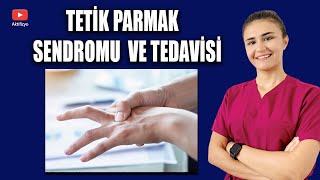 TETİK PARMAK NEDİR TEDAVİSİ [upl. by Juanita525]