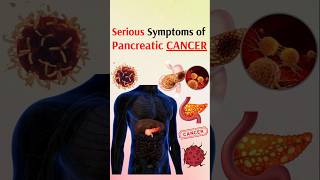 Serious symptoms of pancreatic cancer [upl. by Ching]