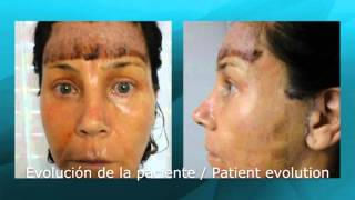 Rejuvenecimiento facial completo 15128 [upl. by Nniw]