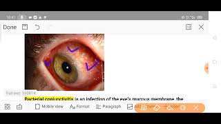 conjunctivitis conjuctivitis [upl. by Nerraj225]