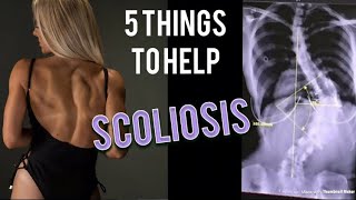 5 things to help SCOLIOSIS [upl. by Brenner537]