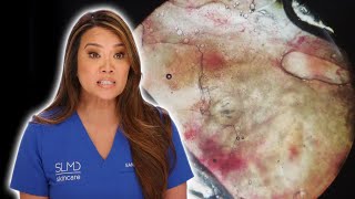 Parasitenbefall  Dr Pimple Popper  TLC Deutschland [upl. by Ahtrim313]