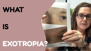 What Is Exotropia And How Do We Treat It [upl. by Trela]