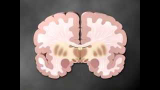 Parkinsons part 1 of 2  Medical Animation by Watermark [upl. by Adraynek24]