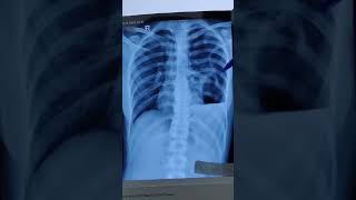 HOW TO DESCRIBE CHEST XRAY OF HYDROPNEUMOTHORAX PNEUMOTHORAX PLEURAL EFFUSIONchestxray ytshorts [upl. by Euqnimod]