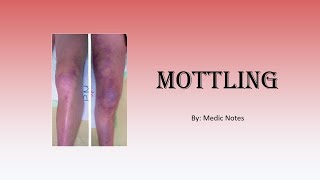 Skin mottling  definition causes pathophysiology sign value [upl. by Ultan]