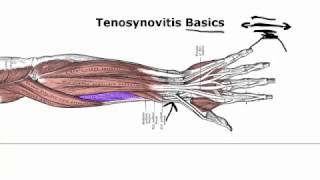 Tenosynovitis Basics Your Doctor Doesnt Tell You [upl. by Zitella]