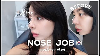 MY NOSE JOB POSTOP VLOG two weeks 🇰🇷  skincare routine  Erna Limdaugh [upl. by Lydon609]