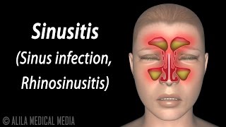 Sinusitis Animation [upl. by Rosemari]