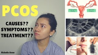 PCOS  Causes Symptoms Treatment  Tagalog [upl. by Teplica]