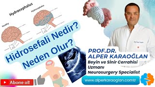 HİDROSEFALİ Hastalığı Nedir Neden Olur  ProfDr Alper KARAOĞLAN [upl. by Eeloj]