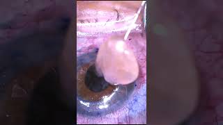 Open Sky Cataract Surgery and Corneal Transplant [upl. by Farman]