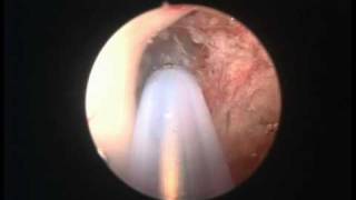 Colloid cyst endoscopy [upl. by Mcgaw]