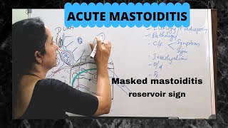 038Acute and Masked Mastoiditis csom [upl. by Aicylla936]