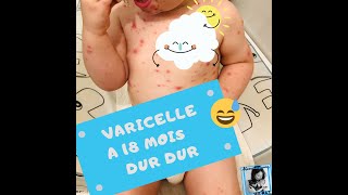 Bébé à la Varicelle comment la soigner  maman1erpas [upl. by Arikal]