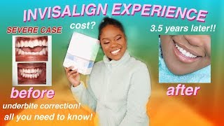 How Invisalign Changed My Life  SEVERE CASE Invisalign Journey before amp after [upl. by Chrissy]