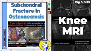 Fig 5B35 Patterns of Subchondral Bone Plate Fracture in Osteonecrosis [upl. by Dahc]