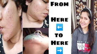 My Journey On Accutane  Sideeffects  Results  Falcon Eye [upl. by Akirahs819]